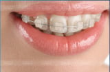 Niềng răng mắc cài sứ mất bao lâu?