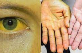 3 dấu hiệu buổi sáng cho thấy bệnh gan đã 'tìm đến bạn': Kiên trì ăn 4 món, gan sẽ khỏe hơn rất nhiều