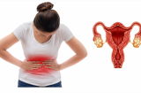 7 dấu hiệu đa nang buồng trứng điển hình, dễ nhận biết