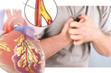 4 dấu hiệu Sh88bet đăng ký miễn phí nhắc bạn hãy cẩn thận kẻo bệnh tim mạch ghé thăm