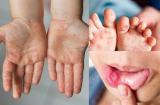 Số ca mắc tay chân miệng gia tăng: BS nói trẻ có 3 dấu hiệu này là bệnh nặng, cần cho đi viện ngay