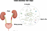 Viêm đường tiết niệu nữ: Nguyên nhân, Triệu chứng, Cách trị