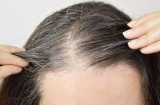 Nhổ tóc bạc 'tưởng không hại nhưng hại không tưởng': BS cảnh báo 5 nguy cơ có thể gặp phải, ai cũng cần biết