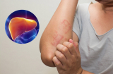 8 dấu hiệu cảnh báo 'gan kêu cứu', cần khám, chữa kịp thời để gan luôn khỏe mạnh