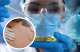 TP.HCM phát hiện 1 ca bệnh đậu mùa khỉ đầu tiên: Nếu có dấu hiệu này cần đi viện ngay lập tức