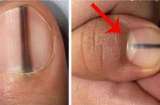 Móng tay xuất hiện sọc đen này, hãy đến gặp bác sĩ ngay lập tức
