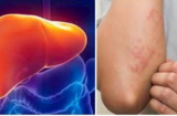 Ngứa 2 vị trí này báo hiệu gan đang kêu cứu, vị trí thứ nhất nhiều người làm tưởng bệnh ngoài da