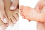 Phụ nữ sở hữu 3 nốt ruồi này quý hơn vàng, may mắn suốt đời, đừng dại tẩy xóa