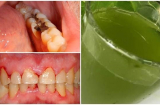 Lấy nắm lá này xay lấy nước súc miệng hàng ngày khỏi lo đau nhức răng, viêm lợi
