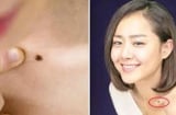 5 nốt ruồi giàu sang, ai sở hữu 1/5 cũng đủ phát tài may mắn hơn người