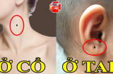 5 nốt ruồi thần Tài đánh dấu, ai có 1/5 cái cũng tha hồ hưởng phúc