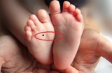 6 nốt ruồi là “thần may mắn”: Có 1 cái thôi thì cả đời không lo cơm ăn áo mặc, ngồi không cũng giàu
