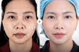 Căng da không Shbet888 tiền thưởng cực khủng -Công nghệ 5.5.10: Vì sao trở thành xu hướng trẻ hóa được phụ nữ sau 40 tuổi lựa chọn?