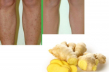 Cách trị vết thâm ở đầu gối cực kỳ hiệu quả giúp các chị em tha hồ diện váy ngắn đón tết