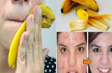Nếu như biết được công dụng làm đẹp thần kỳ của vỏ chuối chắc chắn bạn sẽ không bỏ nó đi