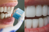 Tỏa sáng mỗi ngày với hàm răng trắng nếu làm theo cách đơn giản này