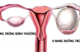 Những dấu hiệu cảnh báo u nang buồng trứng sớm nhất, chị em cần đi khám ngay