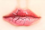 Cách chữa nẻ môi cho chị em vào ngày trời hanh