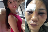 Mẹ đơn thân xinh đẹp bị khách mua hàng online đánh thâm tím mặt mày, nhập viện cấp cứu