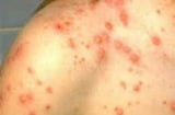 Bệnh sởi mùa hè: nguyên nhân và cách phòng chống