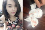 Cô gái trẻ xinh đẹp bị vẹo mũi, đầy dịch vàng vón cục lẫn máu vì tiêm chất làm đầy ở spa