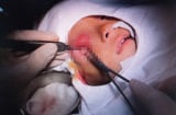 Mẹ chủ quan không điều trị đầy đủ viêm xoang ở mũi cho con, bé 16 tháng tuổi suýt mù vì biến chứng