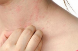 2 dấu hiệu chẳng ai ngờ báo ung thư da nghiêm trọng