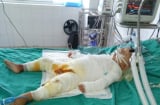 Xót thương bé 18 tháng tuổi bị bỏng nặng, cha mẹ không nơi bấu víu cần sự sẻ chia từ cộng đồng