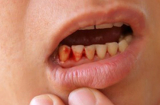Thấy dấu hiệu này hãy tới bác sĩ khám ngay kẻo cứu không kịp