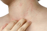 Bệnh viêm da dị ứng là gì?
