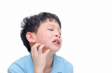 Bệnh quai bị là gì?
