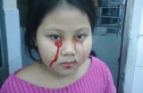 Hi hữu: 3 chị em ruột bị chảy máu miệng, mắt, bố mẹ lo cho con bị nói là dựng chuyện lừa đảo
