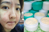 Dưỡng trắng bằng kem trộn, chị em bị 'lột sạch' da mặt, mất hàng trăm triệu điều trị nhưng chỉ phục hồi được 30-40%