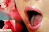 Đây là nhóm người có nguy cơ mắc ung thư miệng cực cao hãy tránh ngay