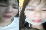 Sẵn sàng bán dây chuyền để giúp người bị thương, cô gái trẻ không hiểu vì sao mình bị đánh lệch mũi, rách miệng