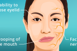 Những biểu hiện của bệnh bại liệt mặt?