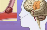 Bệnh rối loạn tuần hoàn não là gì?