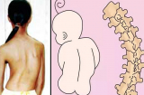 Những sai lầm của cha mẹ khiến con bị GÙ LƯNG, CONG VẸO CỘT SỐNG