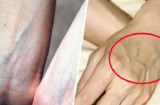 Khi thấy ai đó Sh88bet đăng ký miễn phí có “gân xanh” nổi lên nhất định phải nói cho họ biết điều này để cứu sống họ