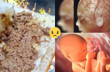 4 loại thực phẩm bà bầu 3 tháng phải tránh xa