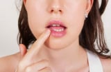 Bệnh viêm loét miệng là gì?