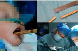 Bé 2 tuổi bị đũa đâm thẳng vào miệng khi mẹ đuổi theo đút cơm