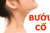 Những biểu hiện của bệnh bướu cổ?