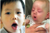 Bệnh ho gà ở trẻ em triệu chứng và cách chữa trị an toàn, hiệu quả nhất