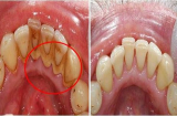 Cao răng bị 'đánh bật' toàn tập sau 5 phút nhờ thứ có sẵn trong nhà này
