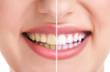 Mẹo để có một hàm răng trắng sáng, tự tin nở nụ cười tỏa nắng