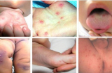 Bệnh tay chân miệng và những lưu ý cần biết tránh biến chứng nguy hiểm