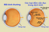 Biểu hiện ẩn đục dịch kính