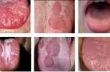 Dấu hiệu nhận biết ung thư lưỡi