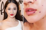 Bệnh tình của ca sĩ Bảo Anh chưa tiến triển, phải nằm phòng cách ly
